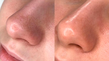 Deep pore cleansing