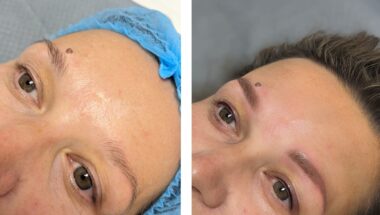 The procedure you see in the image is called permanent makeup. The left picture shows a person's eyebrows before the procedure. The eyebrows are thin and sparse. The right picture shows a person's eyebrows after the procedure. The eyebrows have become thicker and more expressive, which gives the face beauty and confidence.